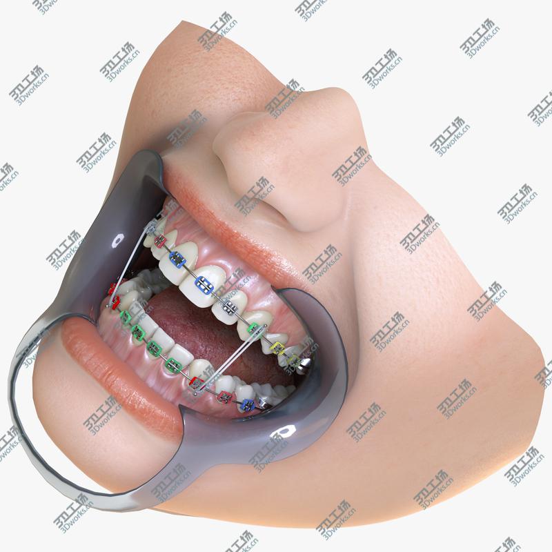 images/goods_img/202104091/Orthodontic Mouth/1.jpg